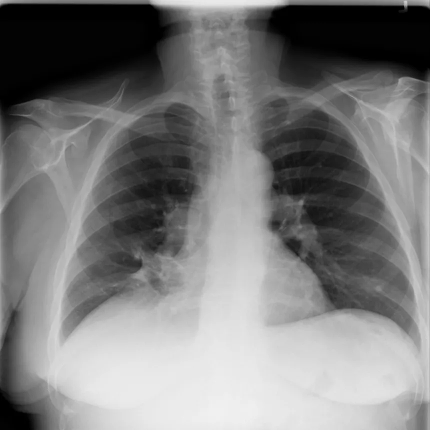 Radiografia de tórax PA, imagem de demonstração do NIH ChestX-ray14